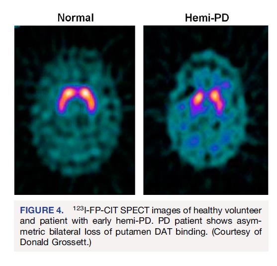 Patofizjologia parkinsonizmu Wolters 2007 presynaptyczny genetyczny toksyczny jatrogenny postynaptyczny pre/postsynaptyczny naczyniowy idiopatyczna choroba Parkinsona