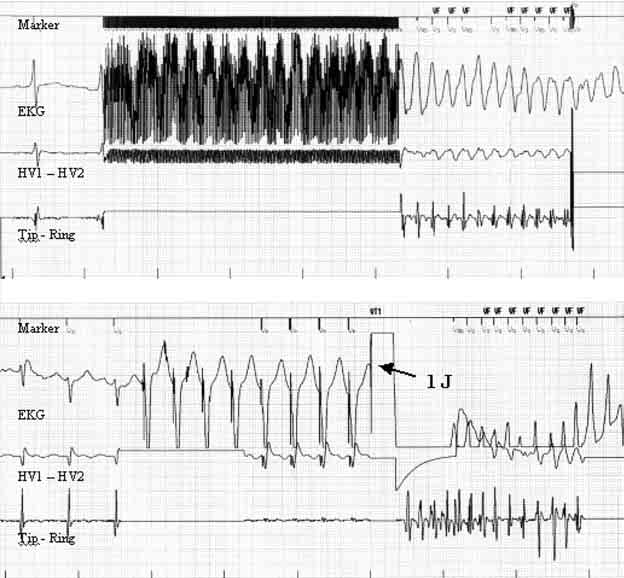 Folia Cardiol. 2003, tom 10, nr 6 Rycina 1. Przykład wywołania migotania komór stymulacją typu burst () i metodą shock on T (). Zapis z programatora iotronik TMS 1000.