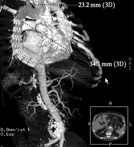 Treatment of a TTA, Motyka et al. arteries, and additional renal arteries departed.
