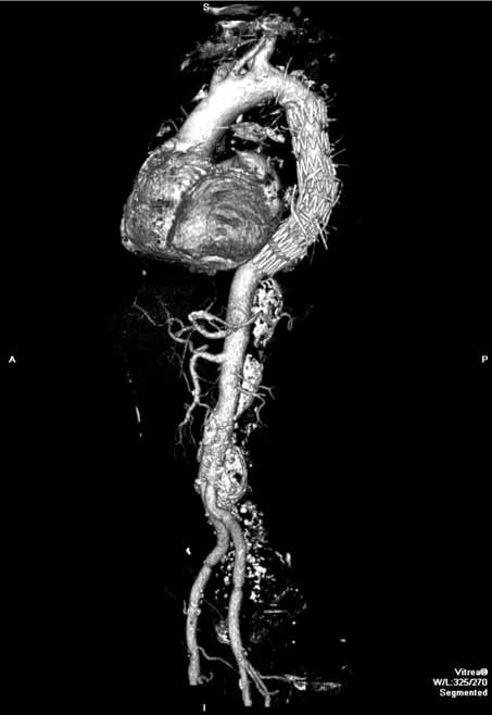 Acta Angiol., 2009, Vol. 15, No. 3 4 Figure 5. Angio-CT study in the 6 th month after surgery Rycina 5. Kontrolne badanie angio-ct przeprowadzone w 6.