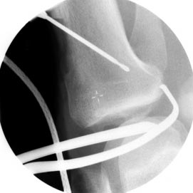 Acta Clinica Single bundle technique Traditionally, reconstruction involved replacing only the anterolateral bundle of the posterior cruciate ligament.