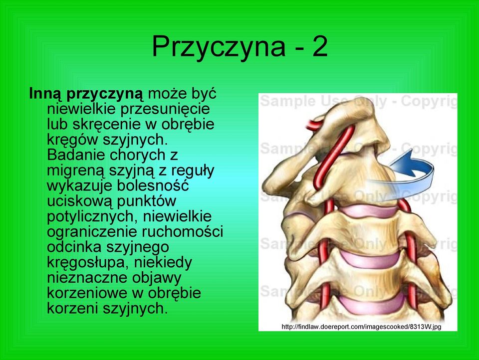 Badanie chorych z migreną szyjną z reguły wykazuje bolesność uciskową punktów potylicznych,