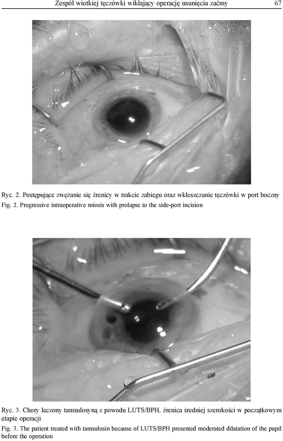 Progressive intraoperative miosis with prolapse to the side-port incision Ryc. 3.