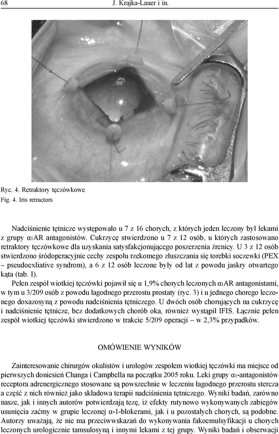 U 3 z 12 osób stwierdzono śródoperacyjnie cechy zespołu rzekomego złuszczania się torebki soczewki (PEX pseudoexliative syndrom), a 6 z 12 osób leczone były od lat z powodu jaskry otwartego kąta (tab.