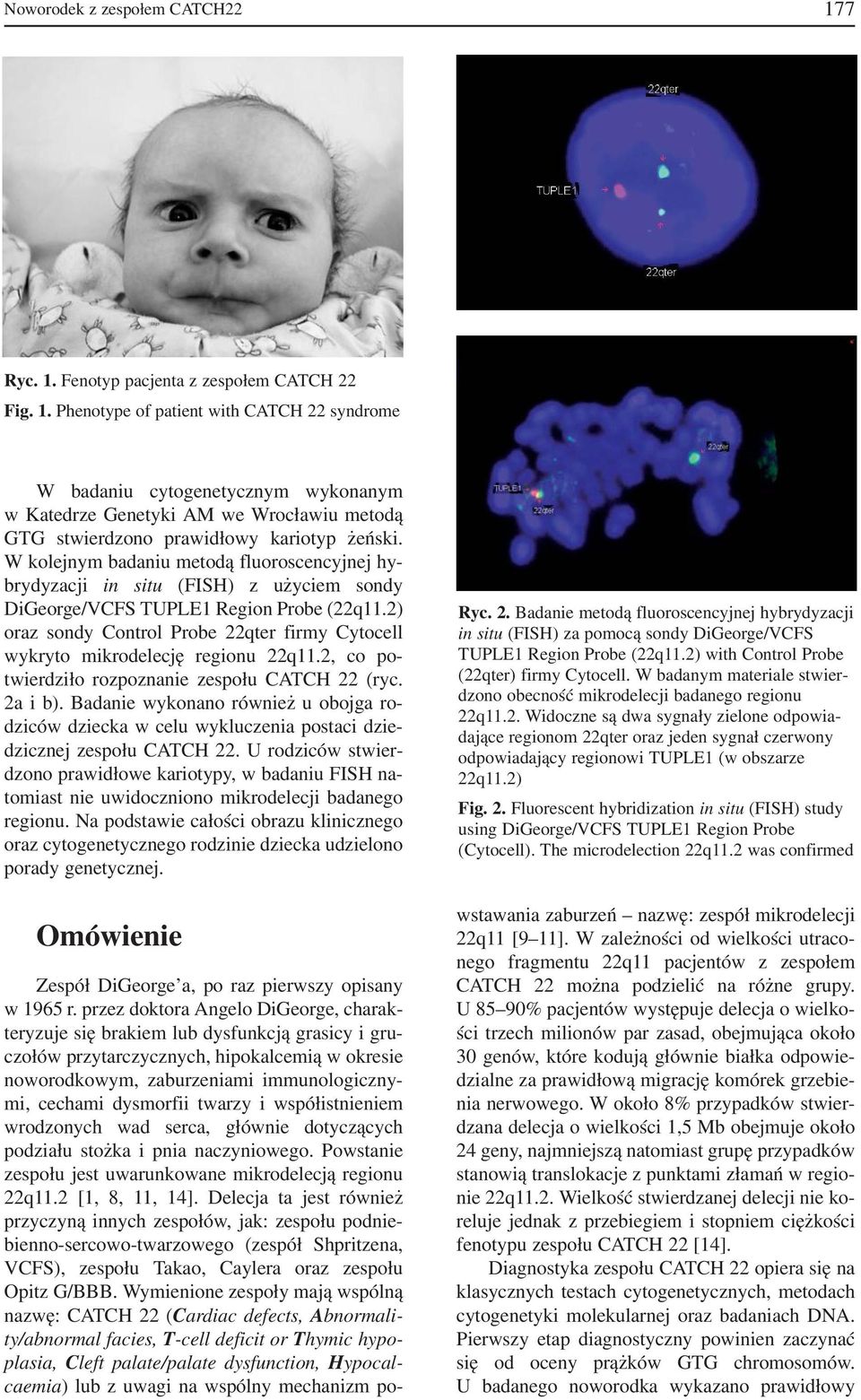 2) oraz sondy Control Probe 22qter firmy Cytocell wykryto mikrodelecję regionu 22q11.2, co po twierdziło rozpoznanie zespołu CATCH 22 (ryc. 2a i b).