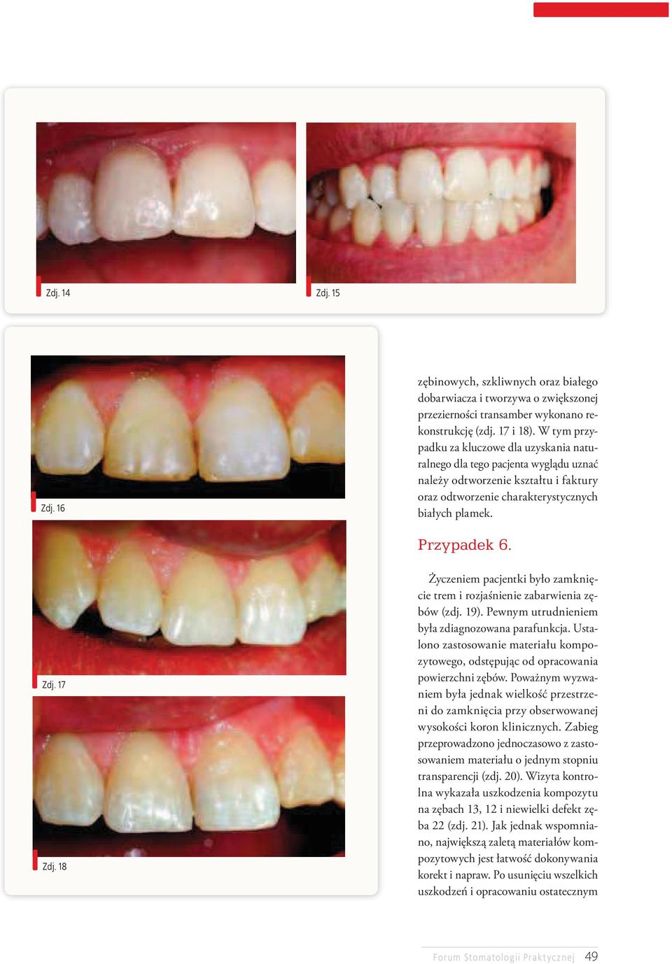 17 Zdj. 18 Życzeniem pacjentki było zamknięcie trem i rozjaśnienie zabarwienia zębów (zdj. 19). Pewnym utrudnieniem była zdiagnozowana parafunkcja.