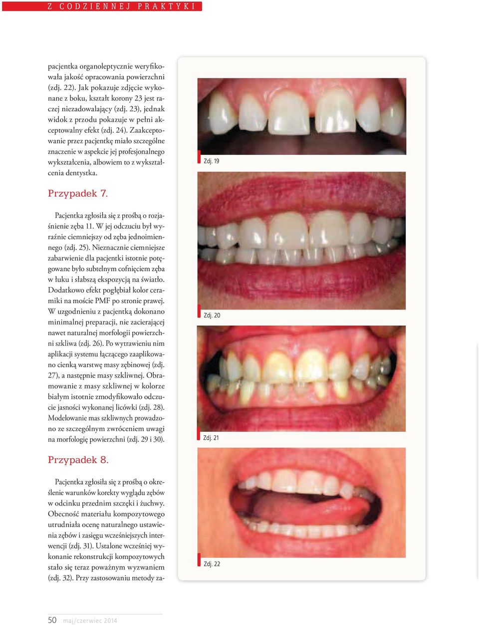 Zaakceptowanie przez pacjentkę miało szczególne znaczenie w aspekcie jej profesjonalnego wykształcenia, albowiem to z wykształcenia dentystka. Zdj. 19 Przypadek 7.