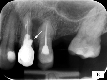 98 TERESA MIKOŁAJCZAK, GRAŻYNA WILK Ryc. 6A. Zdjęcie zęba 24. Projekcja ortoradialna uwidacznia zmianę okołowierzchołkową zlokalizowaną na bocznej ścianie korzenia perforacja nie jest widoczna Fig.