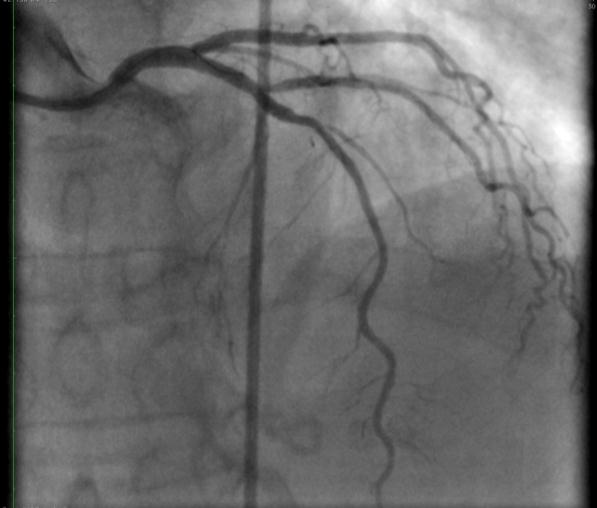 4.6. Ocena angiograficzna W celu ustalenia tętnicy odpowiedzialnej za zawał (infarct related artery; IRA) wykonano badanie koronarograficzne.