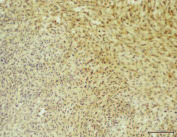 62 Małgorzata Anna Krawczyk A B C Ryc. 18. Silna błonowo-cytoplazmatyczna ekspresja GLUT-1 A. RME (100x) odczynowość (+++) w większości komórek; B.