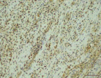 64 Małgorzata Anna Krawczyk A B C Ryc. 20. Cytoplazmatyczna ekspresja VEGF A. RME (100x) silna ekspresja; B. MPNST (200x) silna immunoreaktywność; C. RME (200x) większosc komórek immunonegatywnych; D.