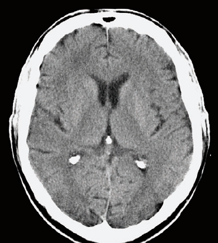 + Anatomia Odnoga przednia torebki wewnętrznej Skorupa Odnoga przednia torebki wewnętrznej Wzgórze