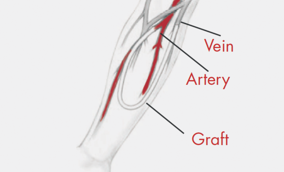 Co to jest têtniczo- ylna proteza naczyniowa? Proteza naczyniowa (graft) to niewielki element z tworzywa sztucznego umieszczony pomiêdzy têtnic¹ i y³¹ na ramieniu lub na udzie.