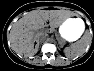 Pacjent z gorączką po przedłużającej się neutropenii. Powyżej zdjęcie CT wątroby w fazie tętniczej pokazuje zmiany typu 2b (strzałka).