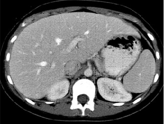 Inny pacjent z gorączką po przedłużającej się neutropenii. Powyżej obraz CT w fazie tętniczej pokazuje zmianę typu 2b (strzałka). Poniżej, w fazie żyły wrotnej zmiana niewidoczna.