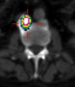 SPECT/CT zmiana zwyrodnieniowa