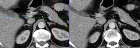 Fuzja PET/CT 68 Ga DOTATOC