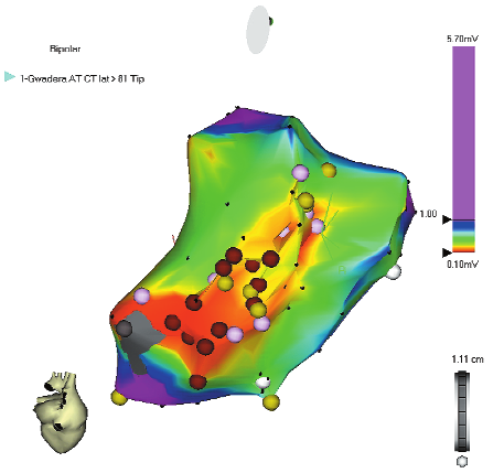 100 ukasz Szumowski et al a b Rycina 4. Carto. a) Mapa aktywacyjna. Kolorem czerwonym oznaczono najwczeœniejsz¹ aktywacjê, a kolorem fioletowym najpóÿniejsz¹.