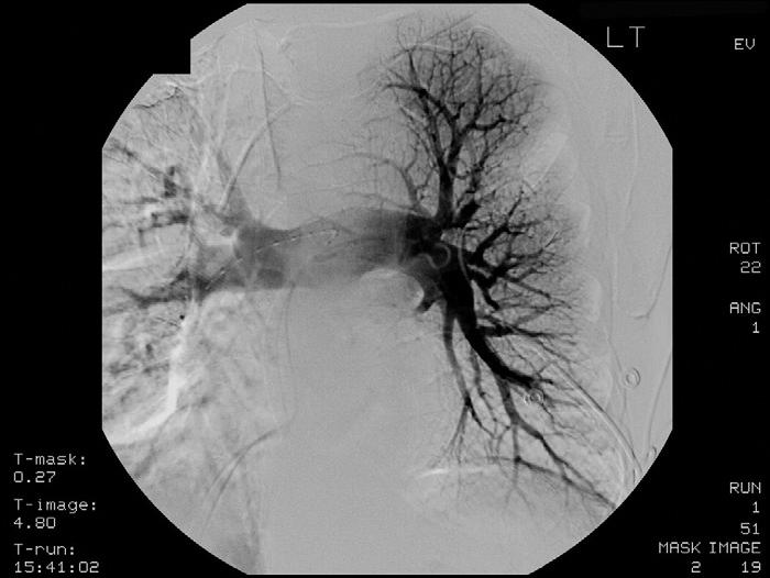 Angiogram of the left pulmonary artery after treatment