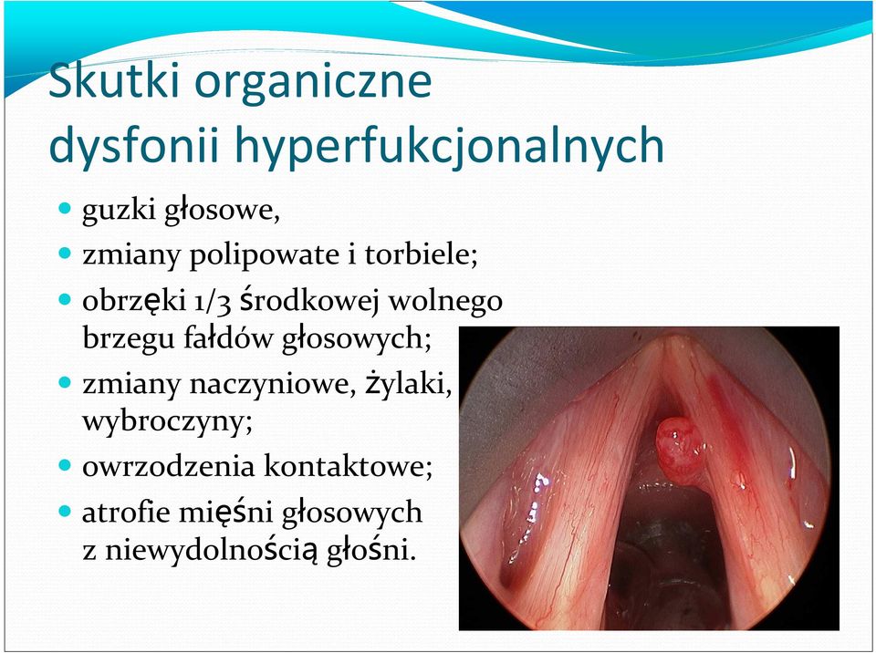 brzegu fałdów głosowych; zmiany naczyniowe, żylaki, wybroczyny;