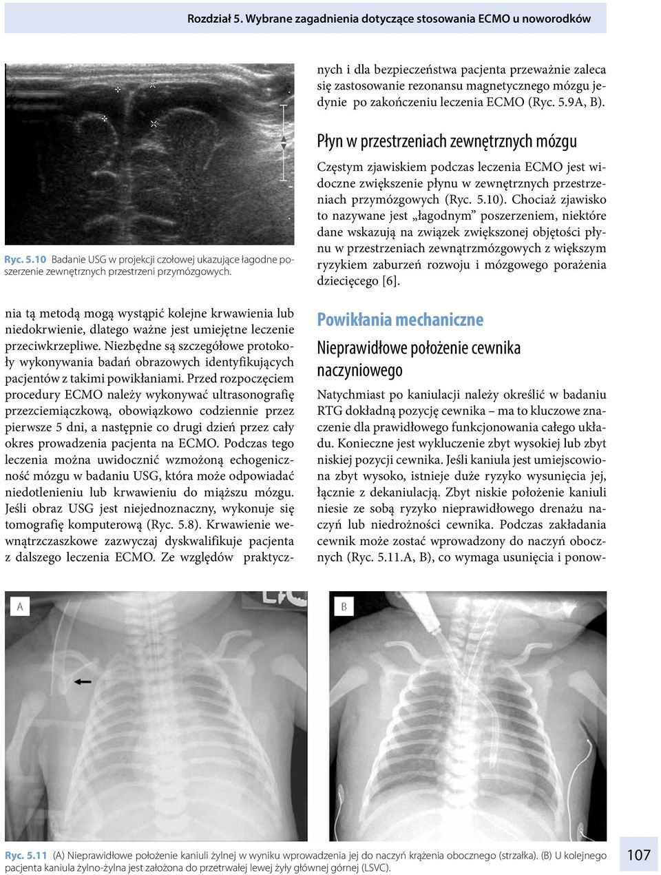 Przed rozpoczęciem procedury ECMO należy wykonywać ultrasonografię przezciemiączkową, obowiązkowo codziennie przez pierwsze 5 dni, a następnie co drugi dzień przez cały okres prowadzenia pacjenta na