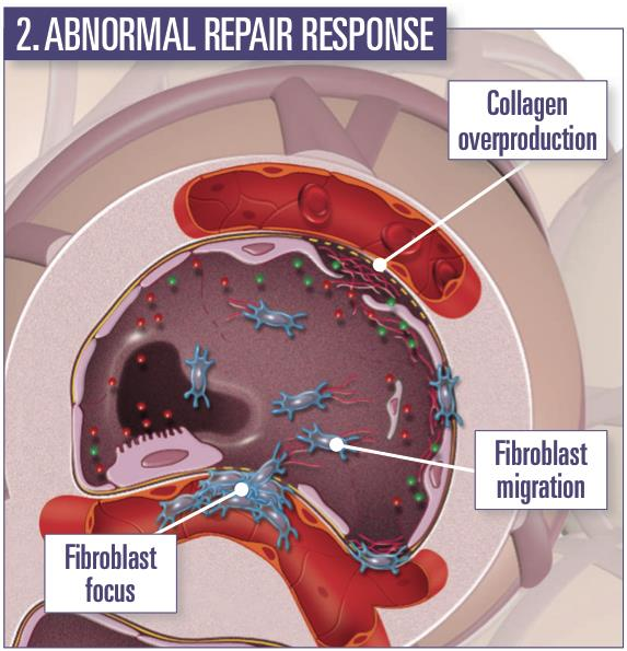 Nieprawidłowa naprawa uszkodzenia Nadprodukcja kolagenu Czynniki profibrotyczne: TGFβ i TNFalfa Migracja fibroblastów Ogniska