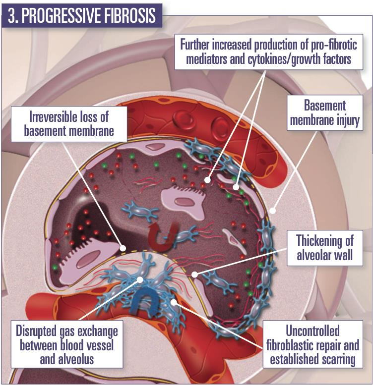 Postępujące włóknienie Dalsza nadprodukcja profibrotycznych mediatorów i cytokin/czcz. wzrostu Nieodwracalne ubytki błony podstawnej Uszkodzenie bł.