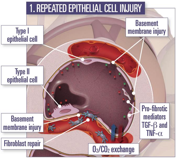 Powtarzające się uszkodzenie komórek nabłonka Pneumocyty I typu Uszkodzenie błony podstawnej Pneumocyty II typu Uszkodzenie błony