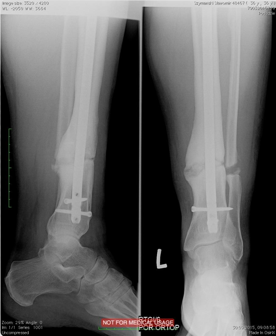 Złamanie kości piszczelowej i