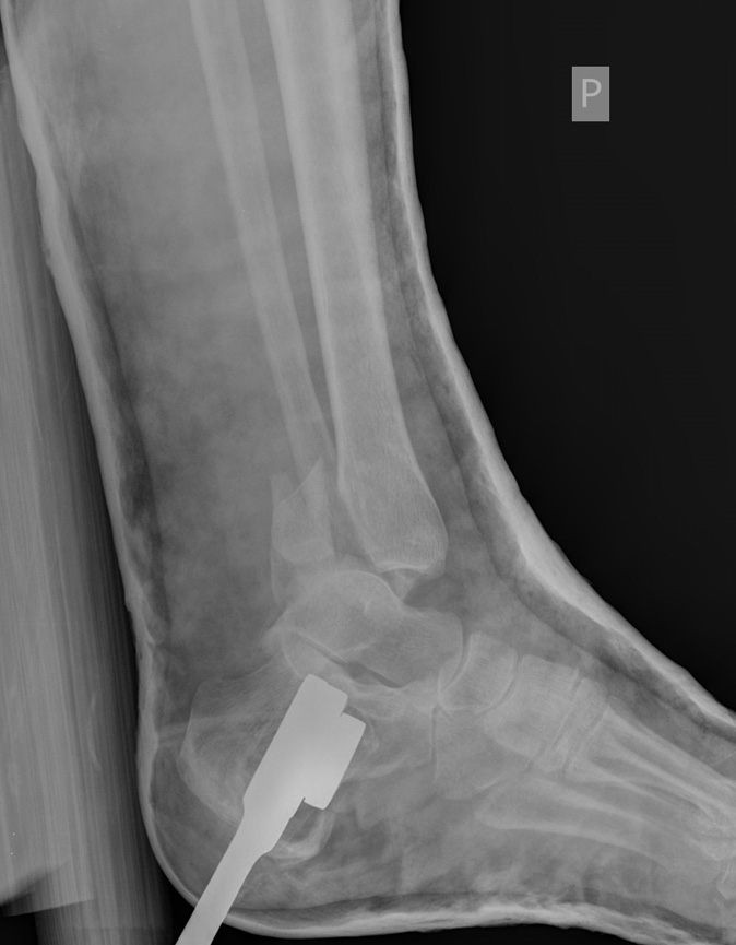 Górski R. et al. Treatment of Fractures with Ilizarov Apparatus U dwóch pa cjen tów (#1, #4) po dwóch la tach od urazu wystąpiła pourazowa artroza stawu skokowego.