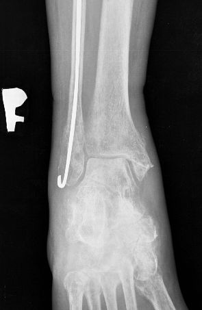 Górski R. et al. Treatment of Fractures with Ilizarov Apparatus Ryc. 7. Stan po zamontowania zawiasów celem ćwiczenia stawu skokowego projekcja przednio-tylna Fig. 7. Status post mounting of hinges for ankle joint exercises anteroposterior view Ryc.