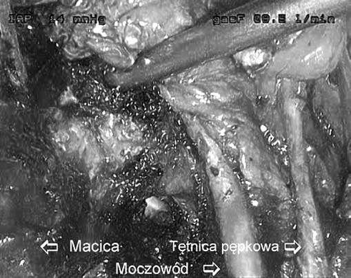Całkowita laparoskopowa radykalna histerektomia z obustronną limfadenektomią miedniczą... Pacjentka i metoda W maju 2010 r.