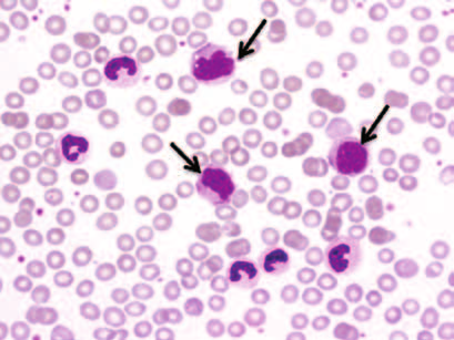 Rozrost linii granulocytowej, słabo widoczne skupienia monocytów z pofałdowanymi jądrami i delikatną chromatyną (zaznaczono dłuższymi strzałkami).