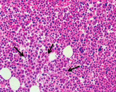 Barwienie immunohistochemiczne z CD34 ujawniające zwiększoną liczbę blastów (barwienie metodą EnVision, 100) D D.