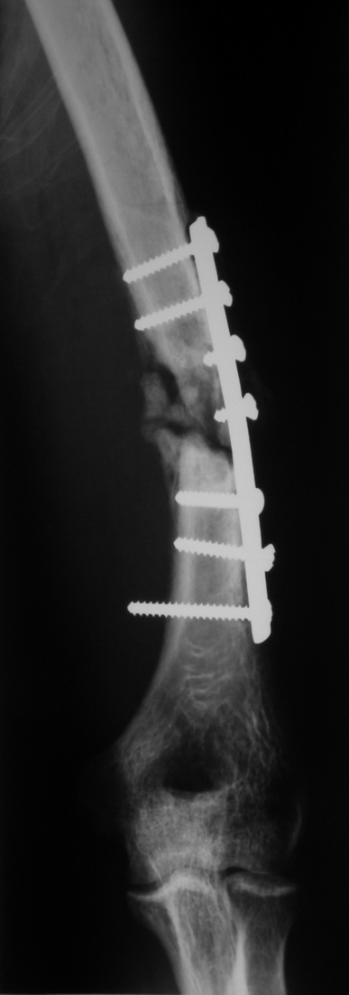 Wójcik K. et al., Locked Intramedullary Nailing in Bone Union Ryc. 1. Rtg ramienia lewego ze stawem łokciowym brak zrostu złamania w 1/3 dalszej trzonu po zespoleniu płytką Fig.1. Left arm radiograph with ulnar joint.