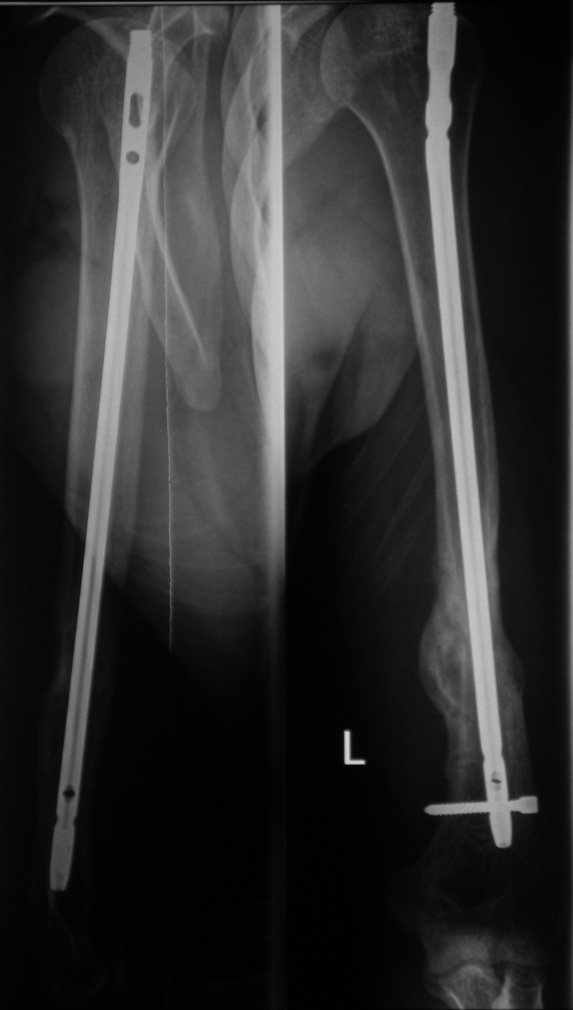 Fixation of bone fragments with locked intramedullary nail.