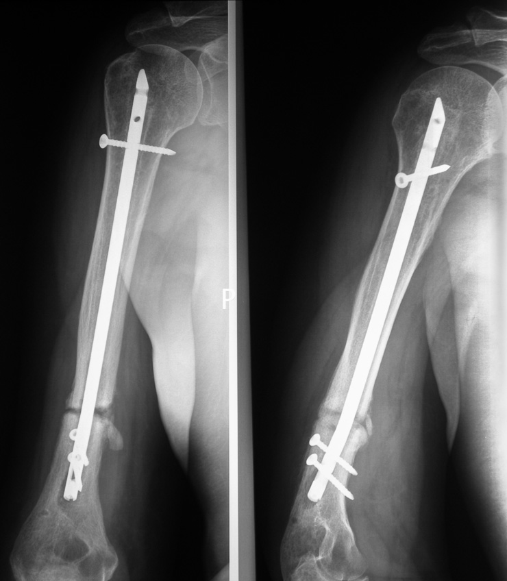 Rtg ramienia prawego odłamy zespolone sposobem zamkniętym gwoździem śródszpikowym ryglo wanym. Brak zrostu złamania Fig. 4. Right arm radiograph.