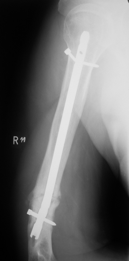 Wójcik K. et al., Locked Intramedullary Nailing in Bone Union Ryc. 5. Rtg ramienia prawego odłamy zespolone sposobem otwartym gwoździem śródszpikowym ryglowanym.