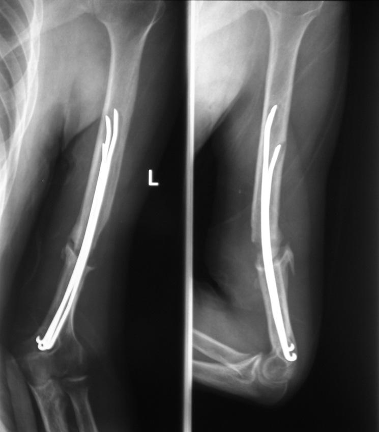 Bone graft at fracture site. Fracture union is seen with good callus consolidation Ryc. 6. Rtg ramienia prawego ze stawem łokciowym. Brak zrostu złamania w 1/3 dalszej po zespoleniu prętami Rusha Fig.