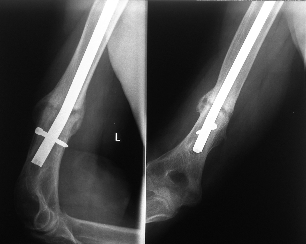 W miejscu zła - mania przeszczep kostny. Zrost złamania z dobrą konsolidacją kostniny Fig. 7. Right arm radiograph. Fixation of bone fragments with open locked intramedullary nail.