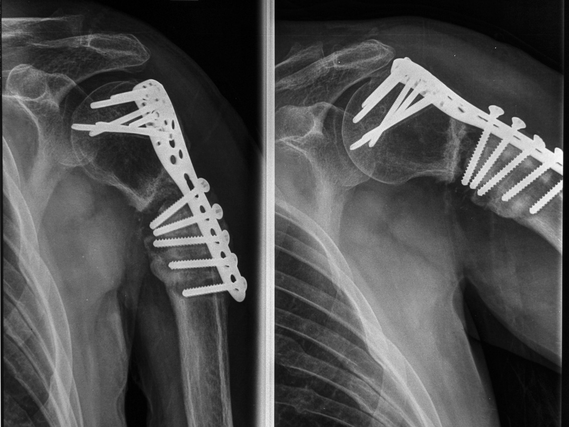 Non-union of proximal metaphysis after Philos plate fixation. Destabilization of fracture fixation wymianie części wkrętów kostnych i dodatkowej stabilizacji płytki metalową pętlą.