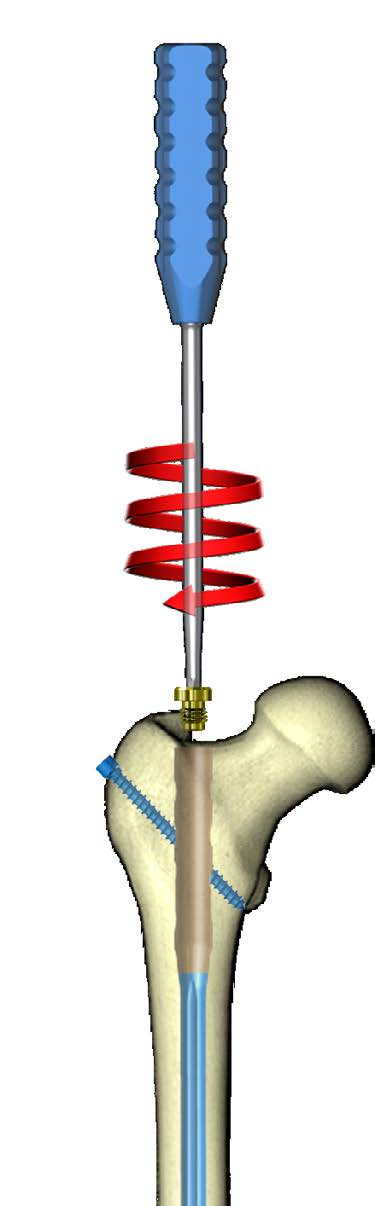 3xx gwóźdź uniwersalny 3.2104.3xx 1.2104.4xx gwóżdź rekonstrukcyjny 3.2104.4xxxx 77 W celu zabezpieczenia gwintu wewnętrznego gwoździa przed zarastaniem tkanką kostną, należy w otwór trzonu gwoździa wkręcić śrubokrętem [40.