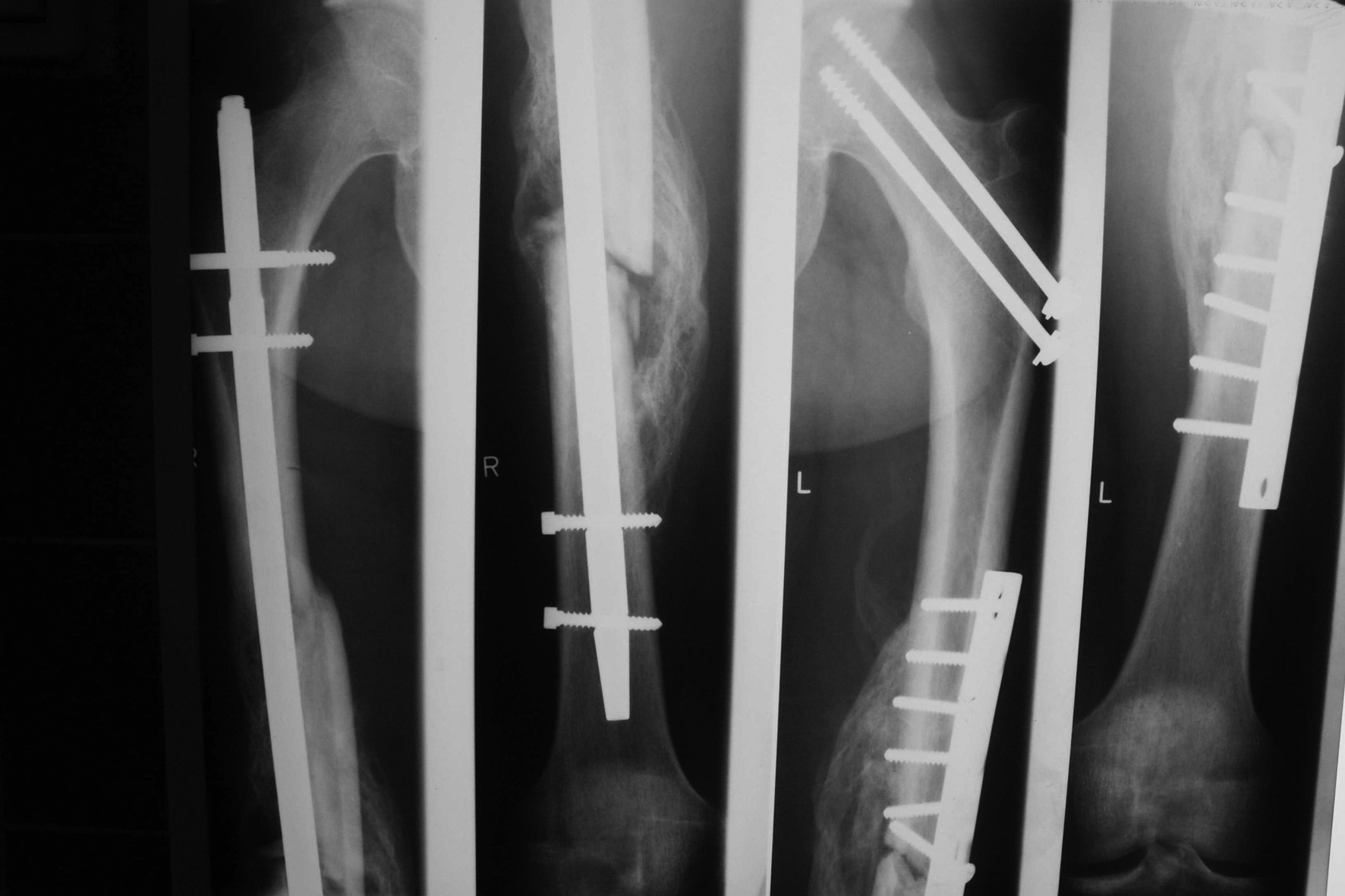 Część złamanej dolnej śruby ryglującej została usunięta Fig. 2a. Femoral shaft fracture with concomitant, hardly visible, non-displaced femoral neck fracture. b.