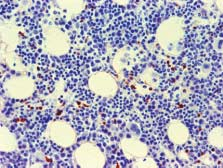 Odczyny z CD3 (A) i CD8 (B) ujawniają zwiększoną liczbę rozproszonych limfocytów T; (C) Odczyn z CD57 dodatni w nielicznych komórkach; (D) Zwiększona liczba niedojrzałych