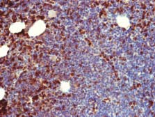 HE, 200; (B) Śródmiąższowe i linijne wewnątrzzatokowe (strzałka) nacieki z limfocytów T (CD4 + ) odpowiadające naciekom białaczki T-LGL; (C) Śródmiąższowe nacieki z limfocytów B (CD23 + )