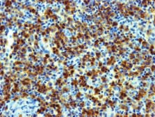 (A) Śródmiąższowe nacieki z odczynowych limfocytów T CD4 + ; (B) Śródmiąższowe nacieki z małych limfocytów B (CD20 + ) odpowiadające naciekom chłoniaka; (C) Pojedyncze komórki prekursorowe linii