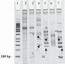 Journal of Transfusion Medicine 2009, tom 2, nr 3 Rycina 4.4.3. Biklonalna białaczka T-LGL TCRgd +. Elektroforeza produktów PCR w badaniu rearanżacji genów kodujących części zmienne łańuchów TCR.
