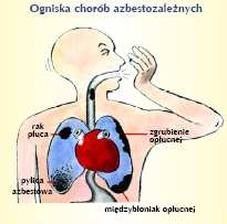 Najczęściej choroba spowodowana przez włókna azbestowe uwidacznia się wiele lat po zaprzestaniu pracy w narażeniu na pył azbestowy. Narażenie zawodowe na pył azbestu może być przyczyną chorób tj.