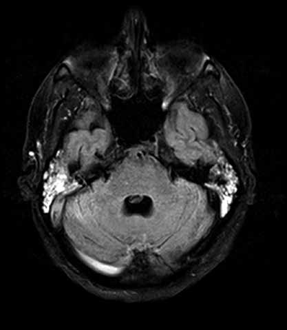 Pourazowa zakrzepica zatok żylnych mózgowia jako powikłanie złamania kości podstawy czaszki Ryc. 1. Rezonans magnetyczny głowy.