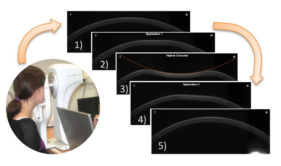 air-puff tonometric examination. Ten healthy volunteers were examined using the Corvis ST. One eye of each subject was measured nine times.